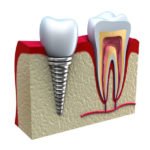 Dental Implants: The Modern Method of Tooth Replacement