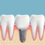 info about dental implants