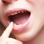 young woman worried about wisdom teeth