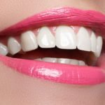 woman with porcelain veneers