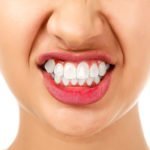 woman with bruxism grinding her teeth