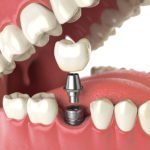 history of dental implants